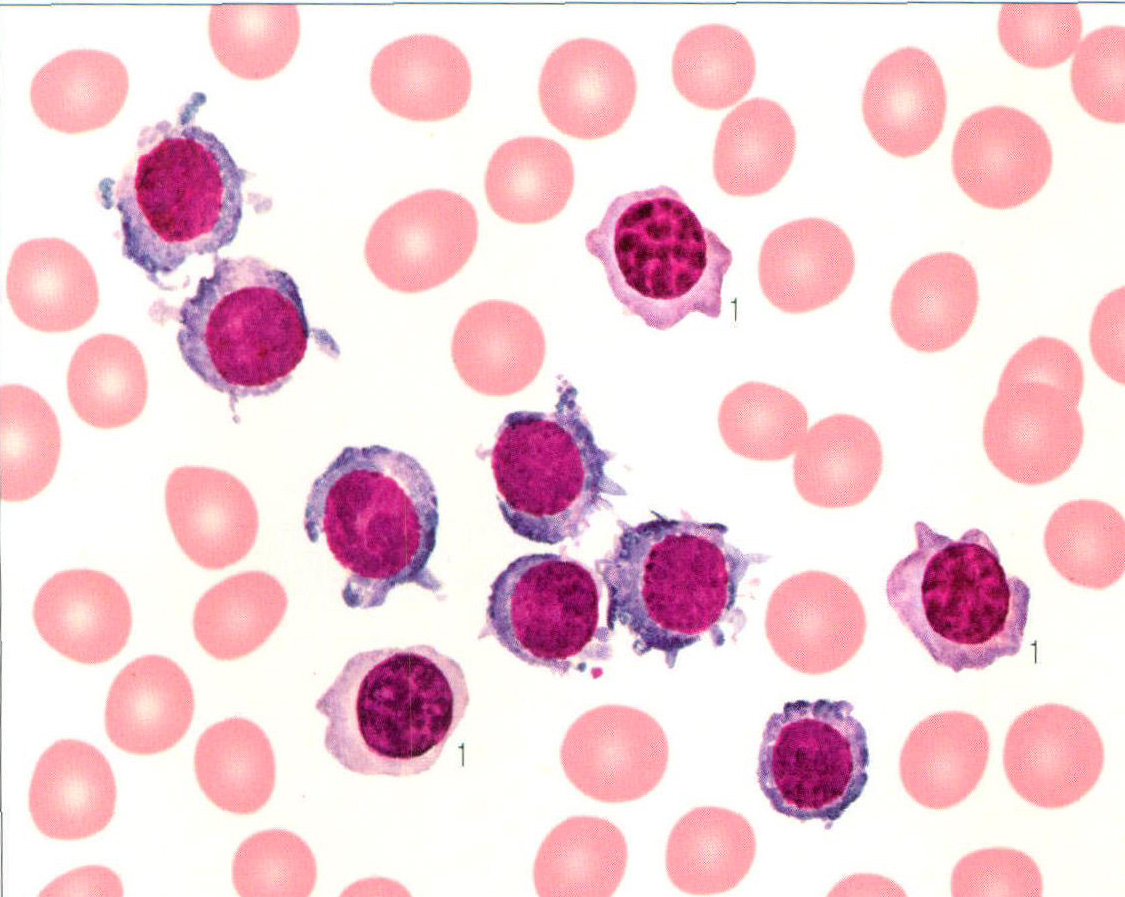 图255 多发性骨髓瘤 (幼浆细胞型)骨髓象(集中视野)-血液学细胞学-医学